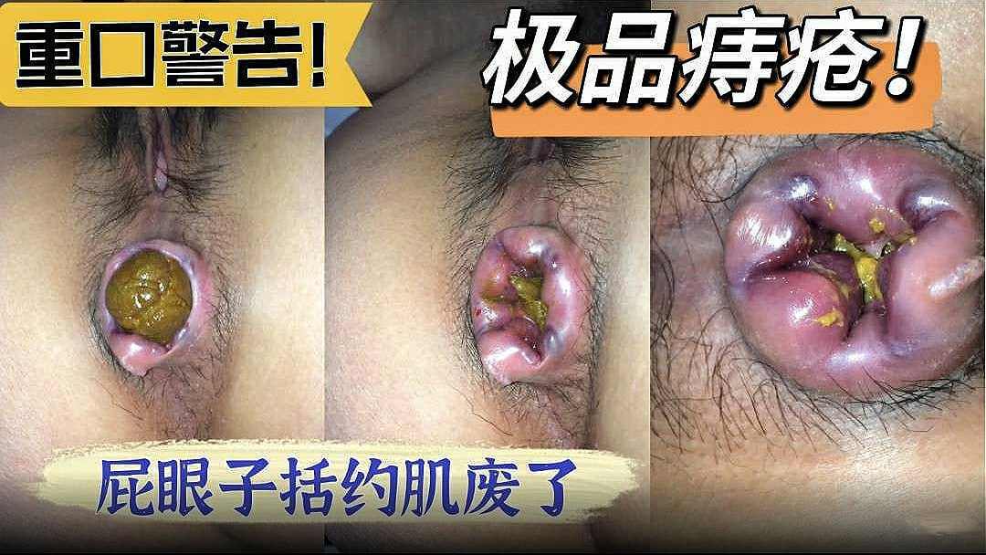 熟女痔疮拉屎奥力给重口